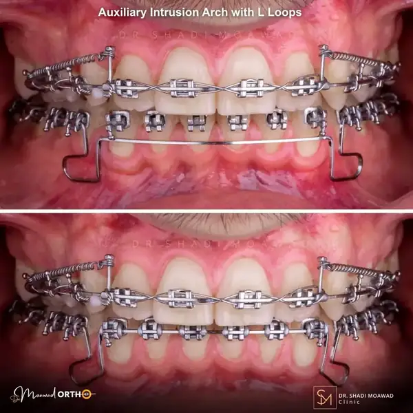 Auxiliary intrusion arch with L loops