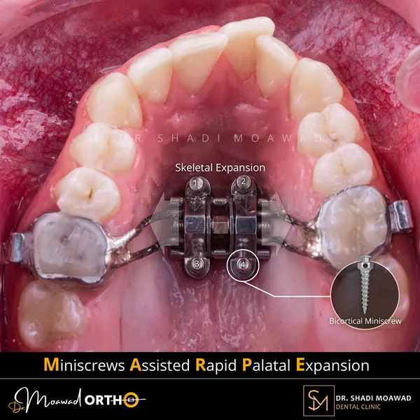 Miniscrew-assisted rapid palatal expansion