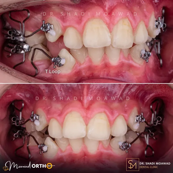 T-loop orthodontic mechanics