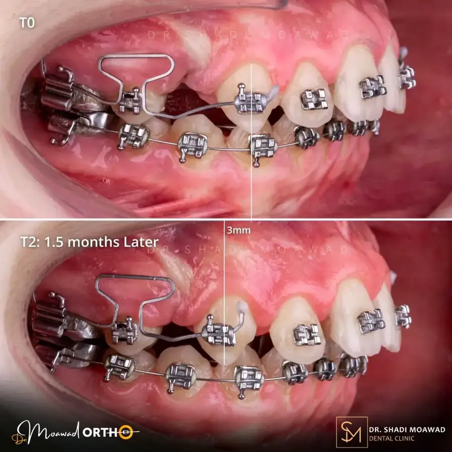 Orthodontic correction — 3 mm