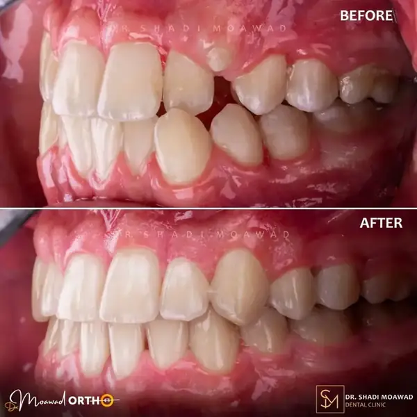 Orthodontic before and after case