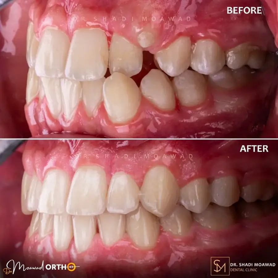 Orthodontic before and after case