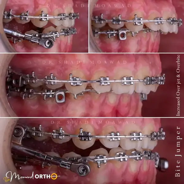 Bite Jumper and Overbite