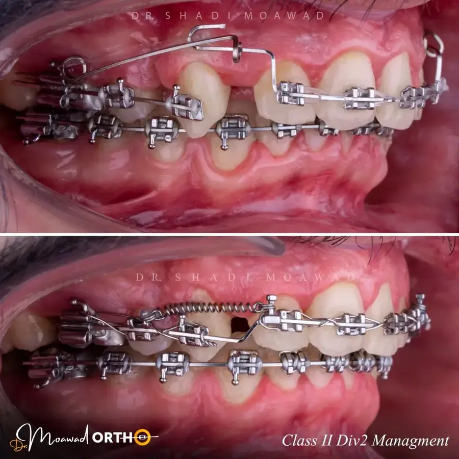 Class II Division 2 orthodontic management
