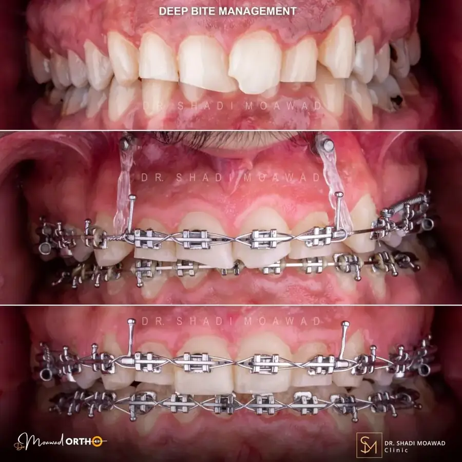 Deep Bite Management