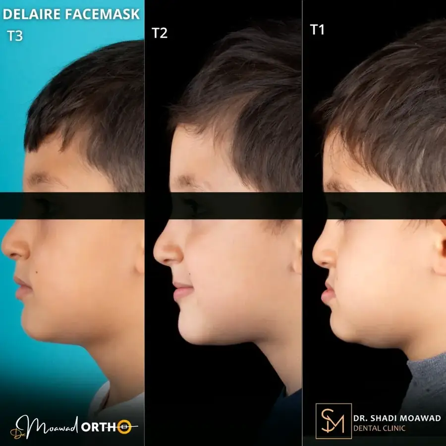 Delaire facemask treatment progression