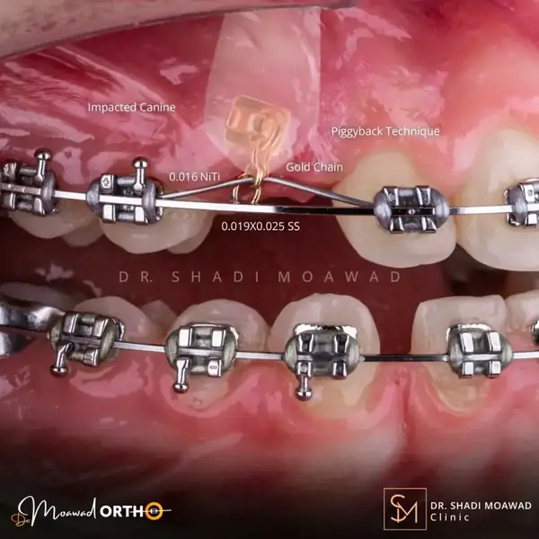 Clear orthodontic aligners