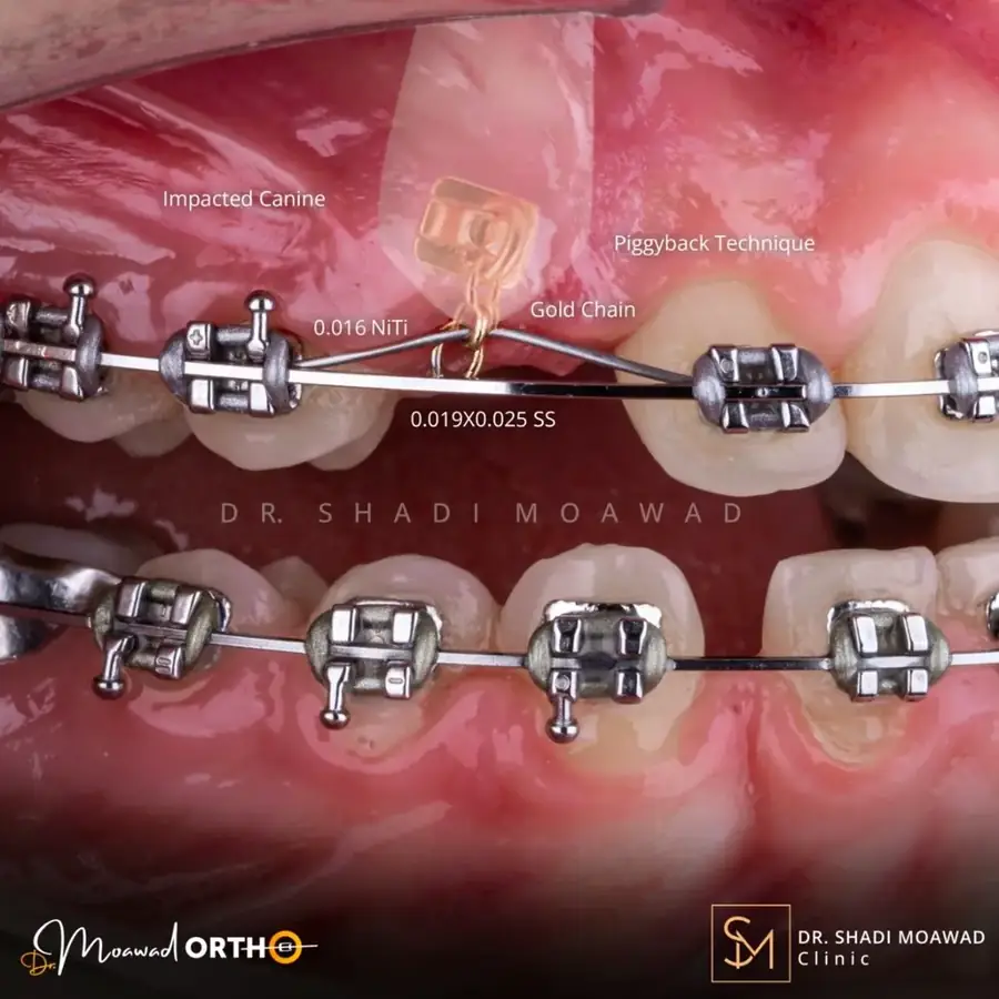 Clear orthodontic aligners